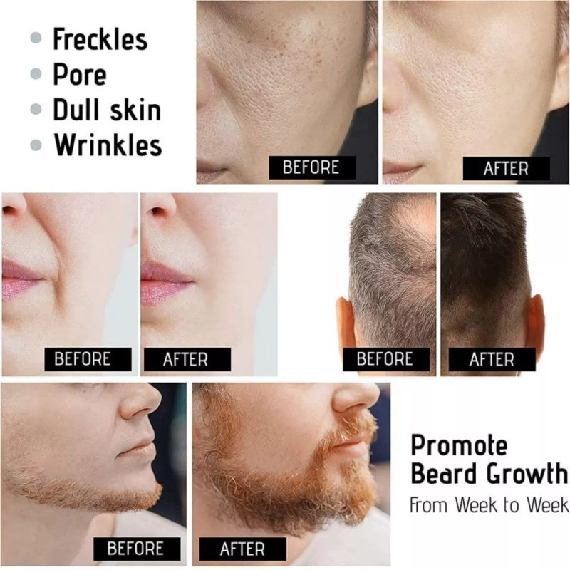 Veraly Rodillo Micro Agujas Dermaroller Crecimiento Pelo Barba