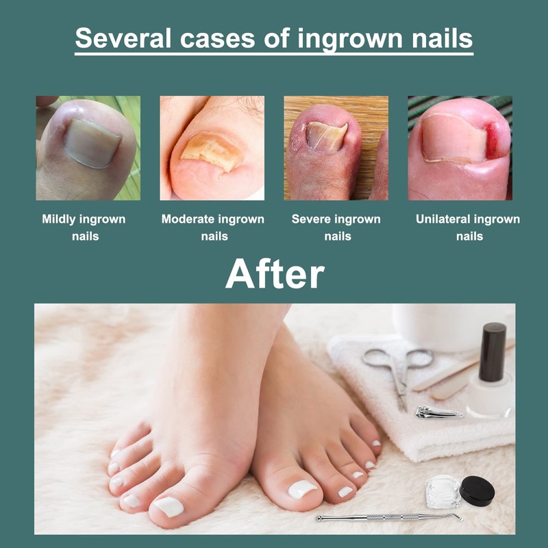 Toenail Corrector 52 Pieces Ingrown Toenails Set Toenail Correction Patch