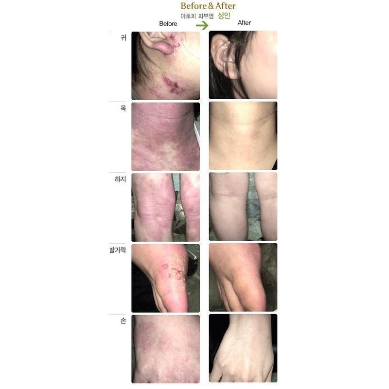 ISAL 3 Lot of ISAL Atopy Eczema Cream Lotion./Made in