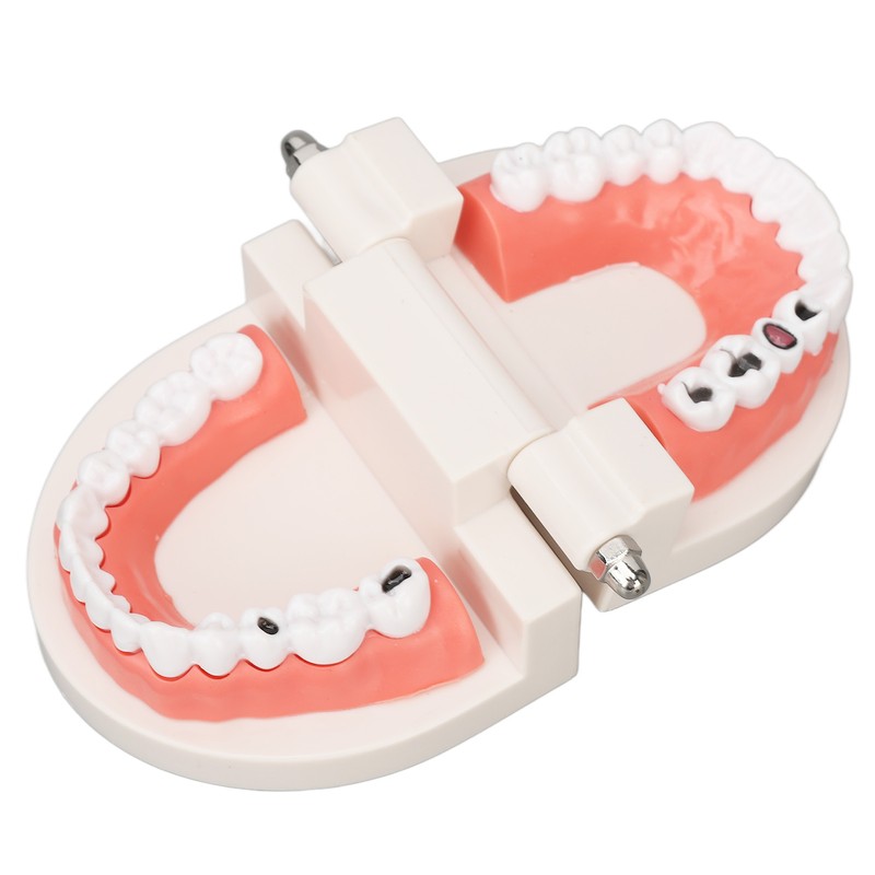 Dental Disease Caries Teeth Model Resin Simulation Teaching Prop Dental