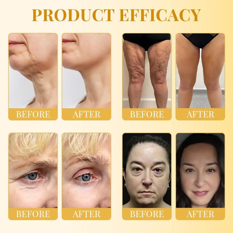 Crema Para El Tratamiento De La Piel, Crema Para Eliminar