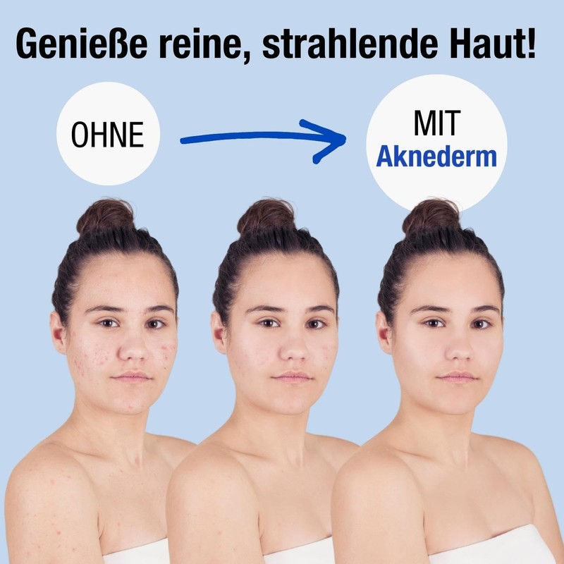 Aknederm Mattifying Face Lotion Against Pimples & Acne 2 x