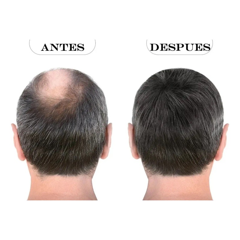 Kit Loción Capilar Noxidil + Roller Cabello The Shaving Co