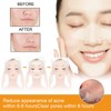 Face Acne Patches Hydrating and Purifying Forehead Nose Chin Cheek
