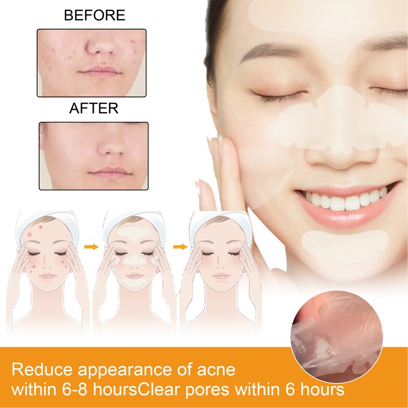 Face Acne Patches Hydrating and Purifying Forehead Nose Chin Cheek
