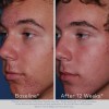 Limpiador Espumoso Facial Obagi Clenziderm M.d. 2% Ácido Sal