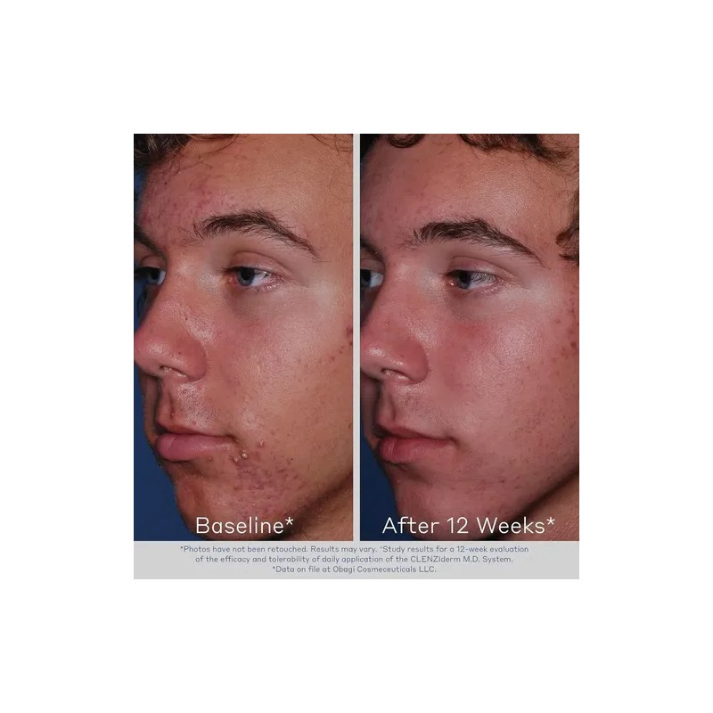 Limpiador Espumoso Facial Obagi Clenziderm M.d. 2% Ácido Sal