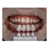 Ultradent Resina Denta Zirconia Forma Ultradent Promocion Bl2 Blanco