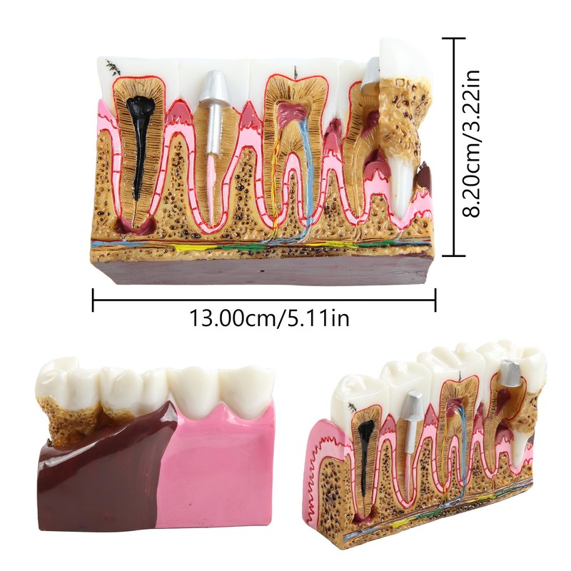 Dental Caries Tooth Anatomy Model Tooth Pathology Models Caries Evolution