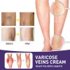 Crema De Tratamiento De Venas Varicosas Crema De Vene