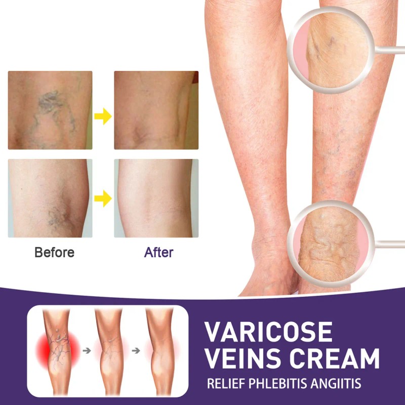 Crema De Tratamiento De Venas Varicosas Crema De Vene