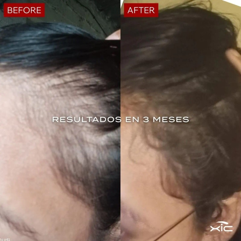 Suplemento Xic Glam Folix Anticada Y Crecimiento De Cabello