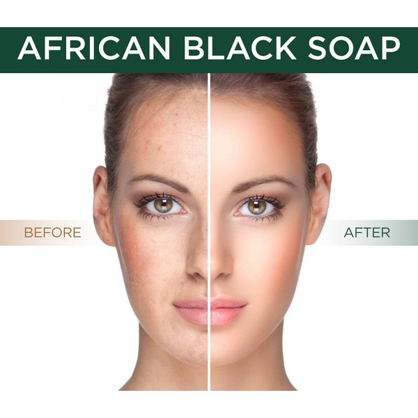 African Black Soap All Natural Best Acne Scar Blemish Blackhead Treatment Cure