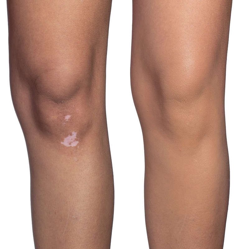 Dermablend Quick-Fix Body Makeup Full Coverage Foundation Stick, Water-Resistant Body