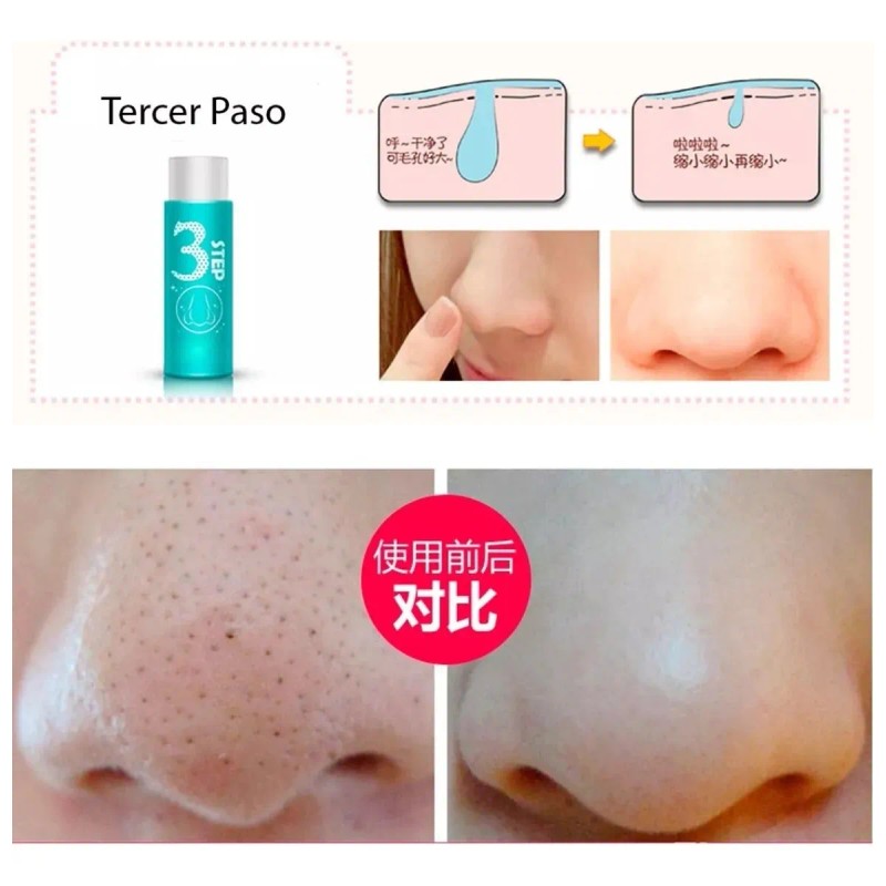 Tratamiento 3 Pasos Puntos Negros Granos, Espinillas Nariz F