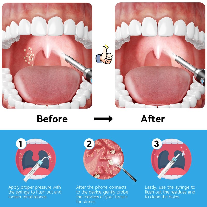 Upgraded Tonsil Stone Remover with Camera, Visual Tonsil Stone Removal