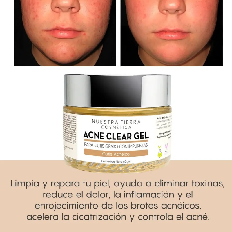 Gel Facial Anti-acné Graso Con Impurezas