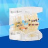 Tratamiento de Ortodoncia Dental de Maloclusión de Dientes Modelo con