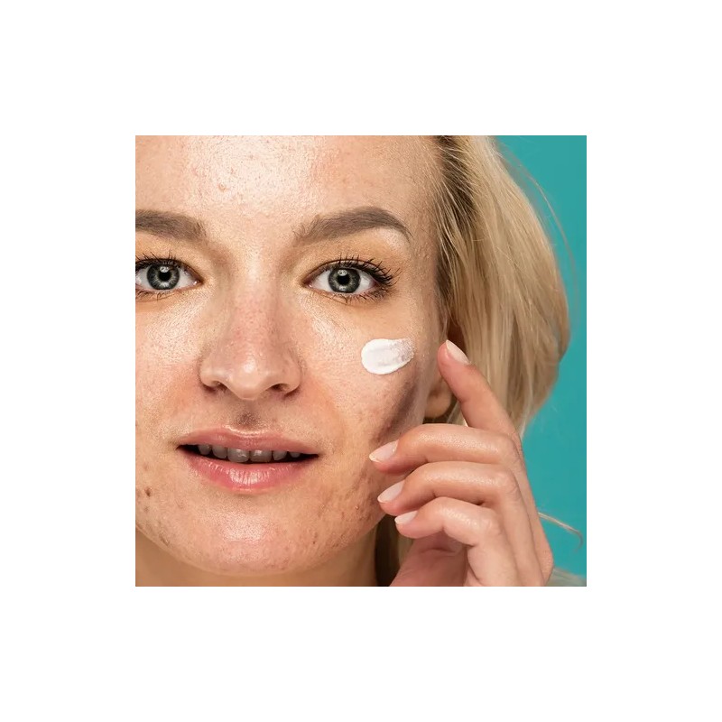 Crema Anti Acné Mc Life Control De Grasa Reduce Manchas
