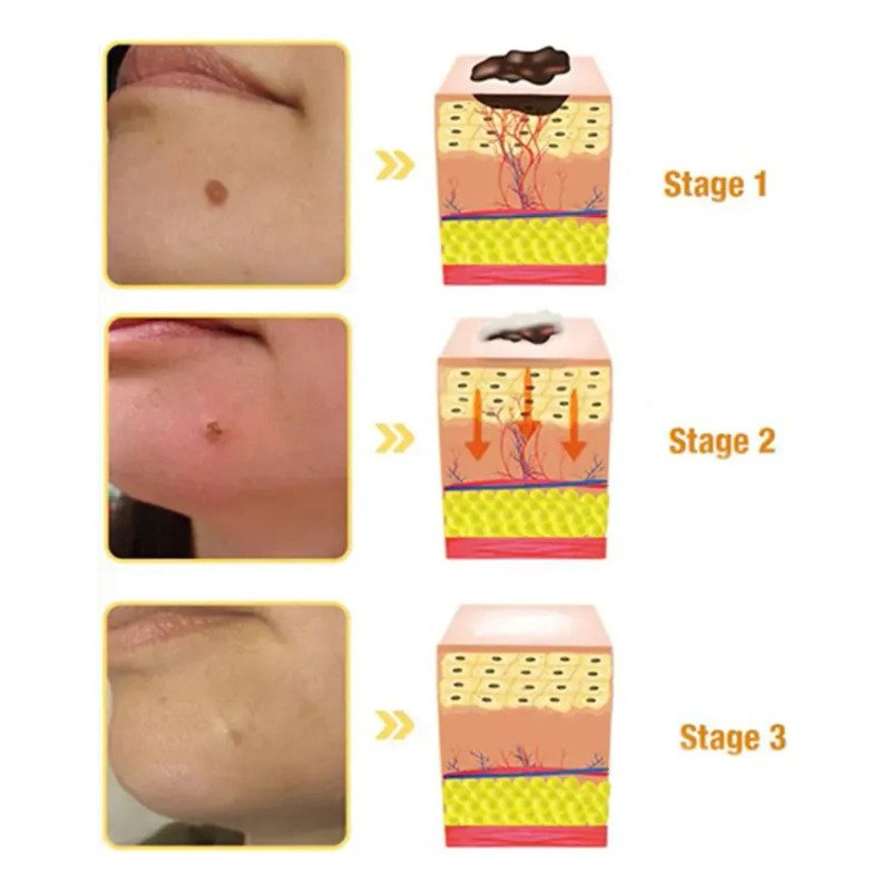 Crema Antipigmentaria Para Eliminar Las Verrugas Del Herpes,