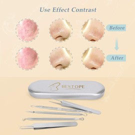 BESTOPE PRO Blackhead Remover, 6 Pieces Acne Remover Set - Tweezers Set with Metal Case Blackhead Remover Tool Made of High Quality Stainless Steel