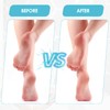Scholl Callus Remover Replacement Rollers, Bolasen Pack of 10 Extra