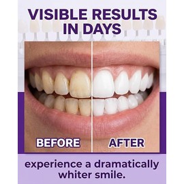 28Pcs Tiras Blanqueadoras Dientes,tiras para Blanquear