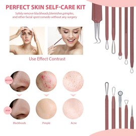 JPNK Blackhead Remover Tool Comedones Extractor Acne Removal Kit for Blemish, Whitehead Popping, 6 Pcs Zit Removing for Nose Face Tools with a Leather Bag (Pink)