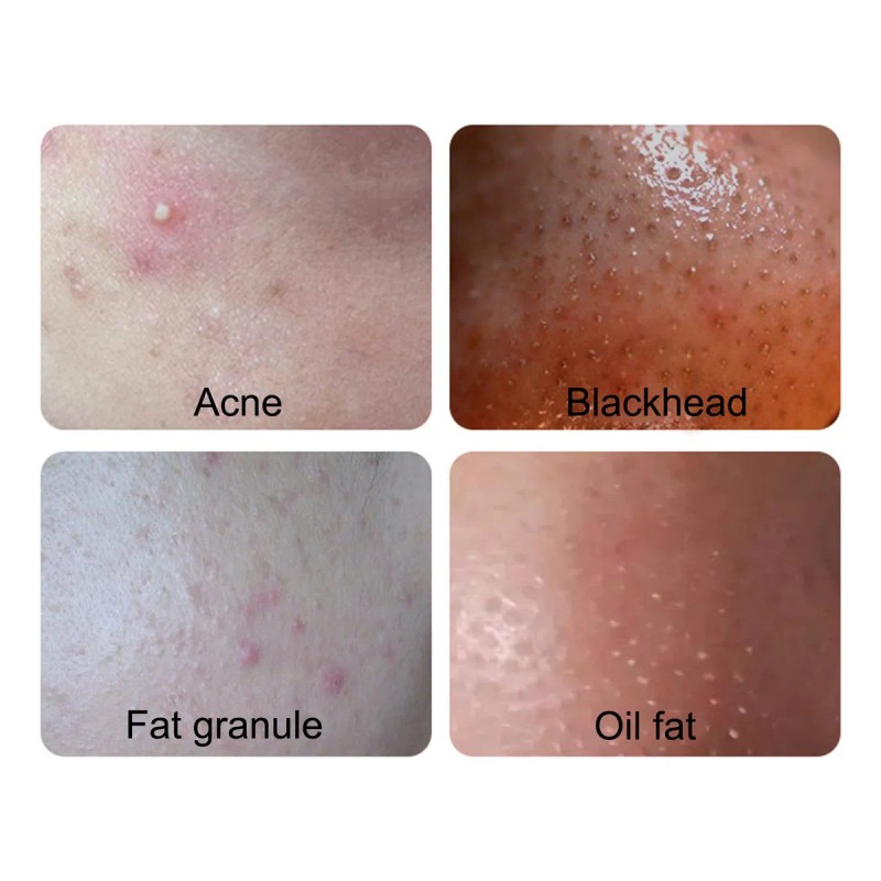 Kit De Tratamiento Para Eliminar El Acné Con Comedones Para