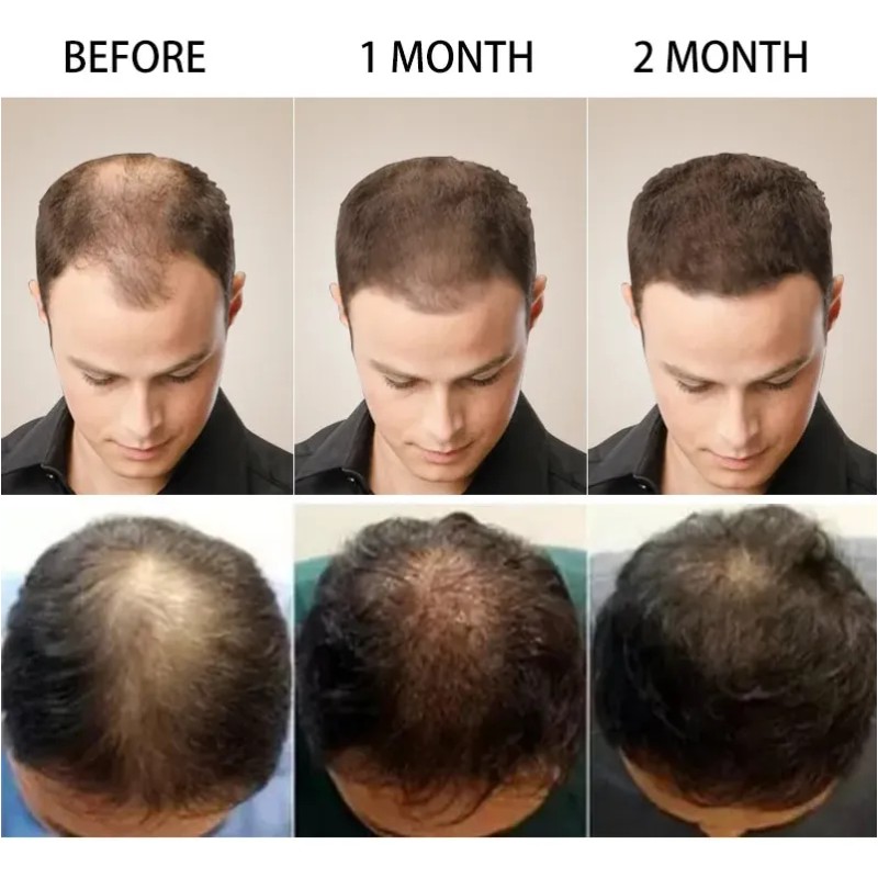 Tónico Capilar Importado Contra La Caída Del Cabello