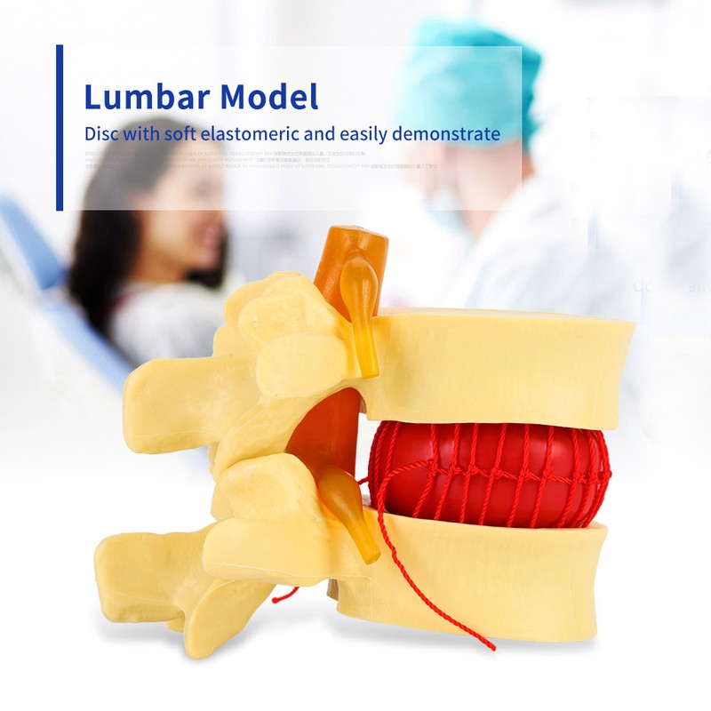 1:1.5 Anatomical Medical Human Spine Lumbar Disc Herniation Demonstration Model