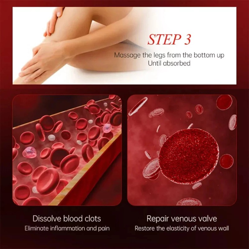 Varicose Veins Relief
