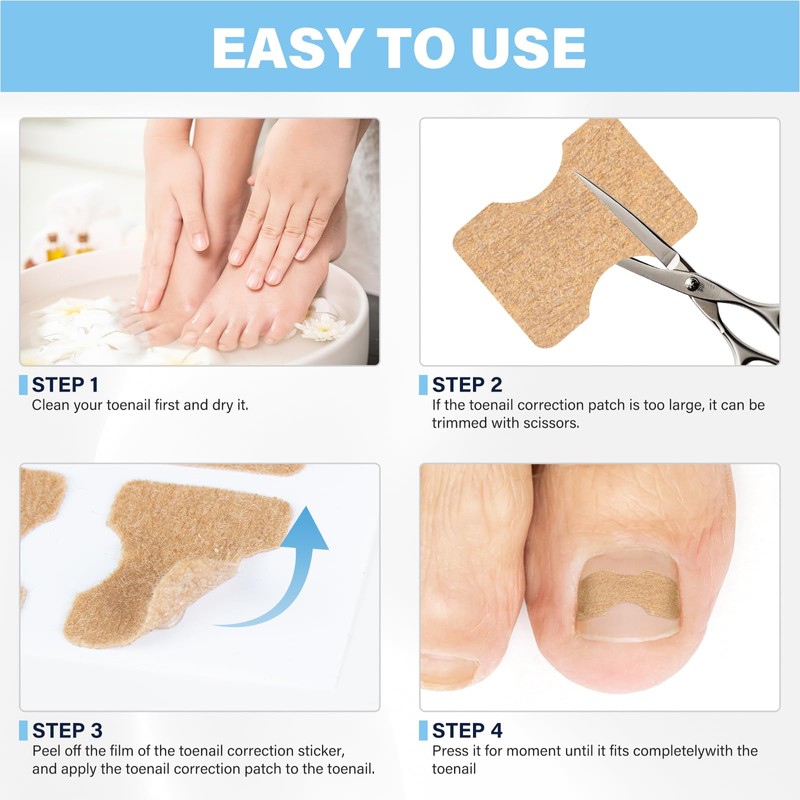 50 Pcs No Glue Breathable Corrector Patch,Painless ingrown toenail Corrector,Nail