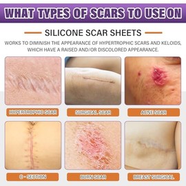 Hojas de silicona para cicatrices, cinta de silicona para cicatrices, tiras de silicona para eliminación de cicatrices para cirugía, cesárea, abdomino