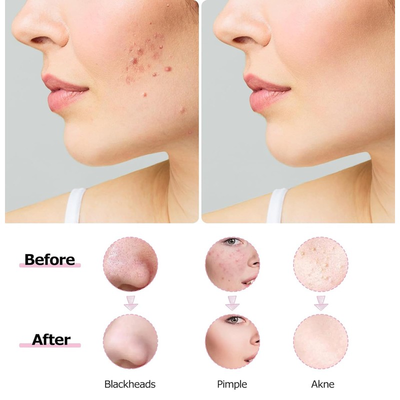 XingFuDM 2 Piece Blackhead Removal Tool & Blemishes Blackhead Remover