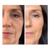 Crema De Noche Anti Acne + Gel Anti Edad De