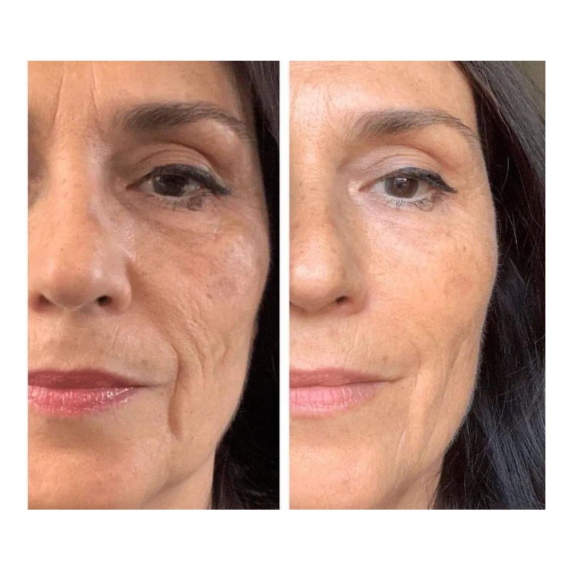 Crema De Noche Anti Acne + Gel Anti Edad De