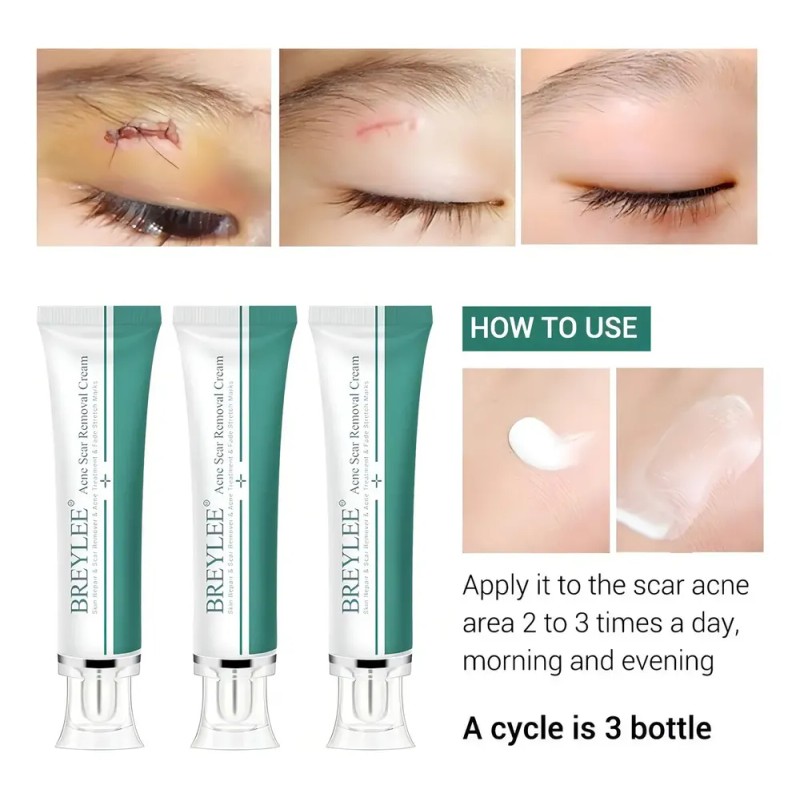 Breylee | Crema Elimina Estrías, Cicatrices, Acné Y Manchas
