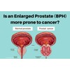 SUPPLEMENT4ME.COM NATURAL HELP FOR ENLARGED PROSTATE (BPH) - 100% HERBAL