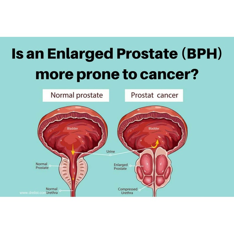 SUPPLEMENT4ME.COM NATURAL HELP FOR ENLARGED PROSTATE (BPH) - 100% HERBAL