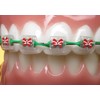 Snapcaps Braces Bumper Cover, Orthodontic Bracket Wax Substitute, Alternative Snap-on