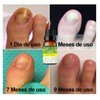 Aceite Esencial De Árbol De Té Antimicotico 100% Natural (10