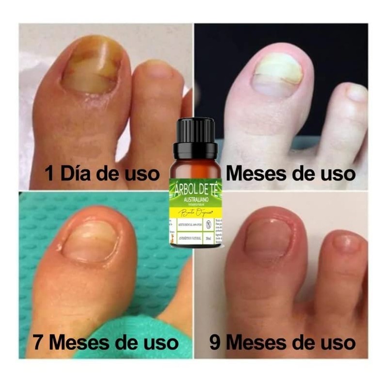 Aceite Esencial De Árbol De Té Antimicotico 100% Natural (10