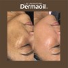 Tratamiento Avanzado Y Completo Para Melasma ( Paño )