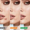 NEARPOW 380 Parches Acné, Pimple Patch Multitamaño Formas Variadas Cara