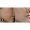 Tratamiento 100% Natural Arrugas Manchas Acne Ojeras Negras