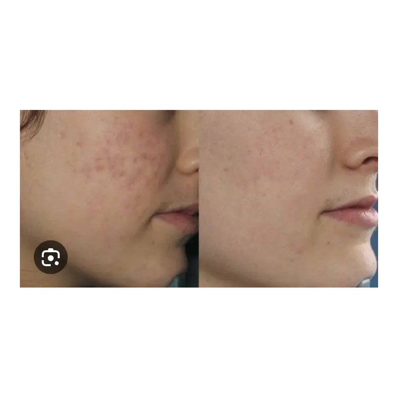 Tratamiento 100% Natural Arrugas Manchas Acne Ojeras Negras
