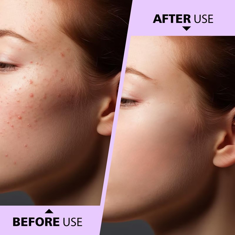 Teenitor Pimple Extractor Acne Treatment Tool Surgical Grade Blackhead Comedone