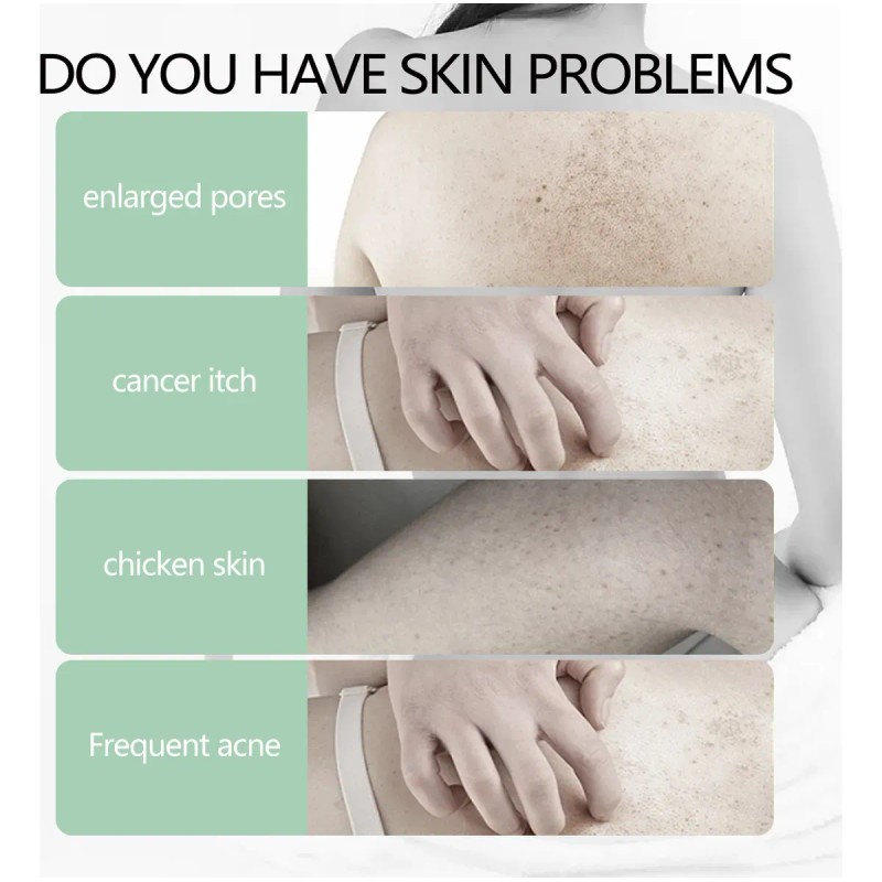 Crema Reparadora De Piel De Pollo Que Cura La Queratosis