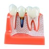 Dental Implant Educational Model, 4X Size, Demonstration Crown and Bridge